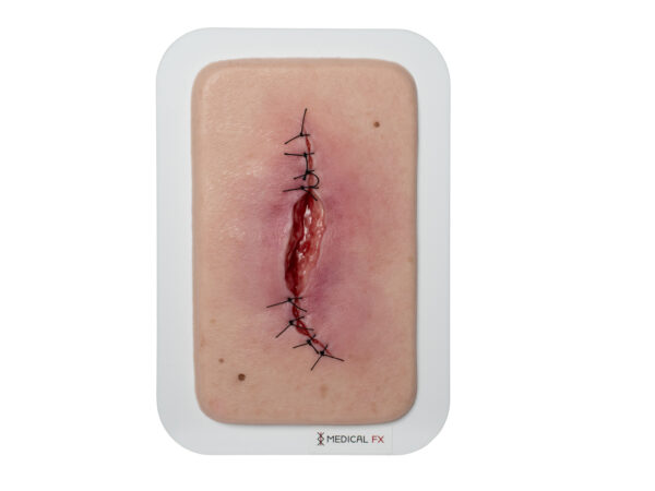 Pocketwound Surgical Wound half-open
