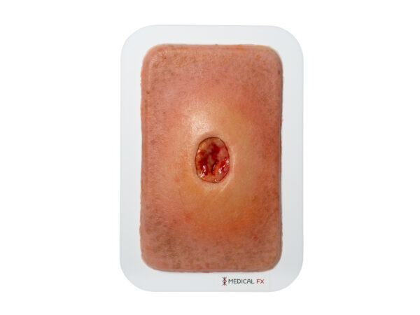 Pocketwunde Verhornung – Bild 6