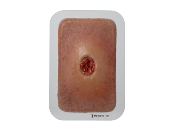 Pocketwound Keratinization - Image 6