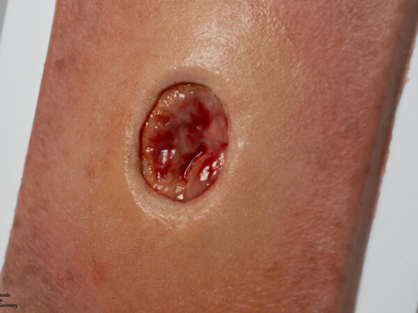 Pocketwound Keratinization - Image 2