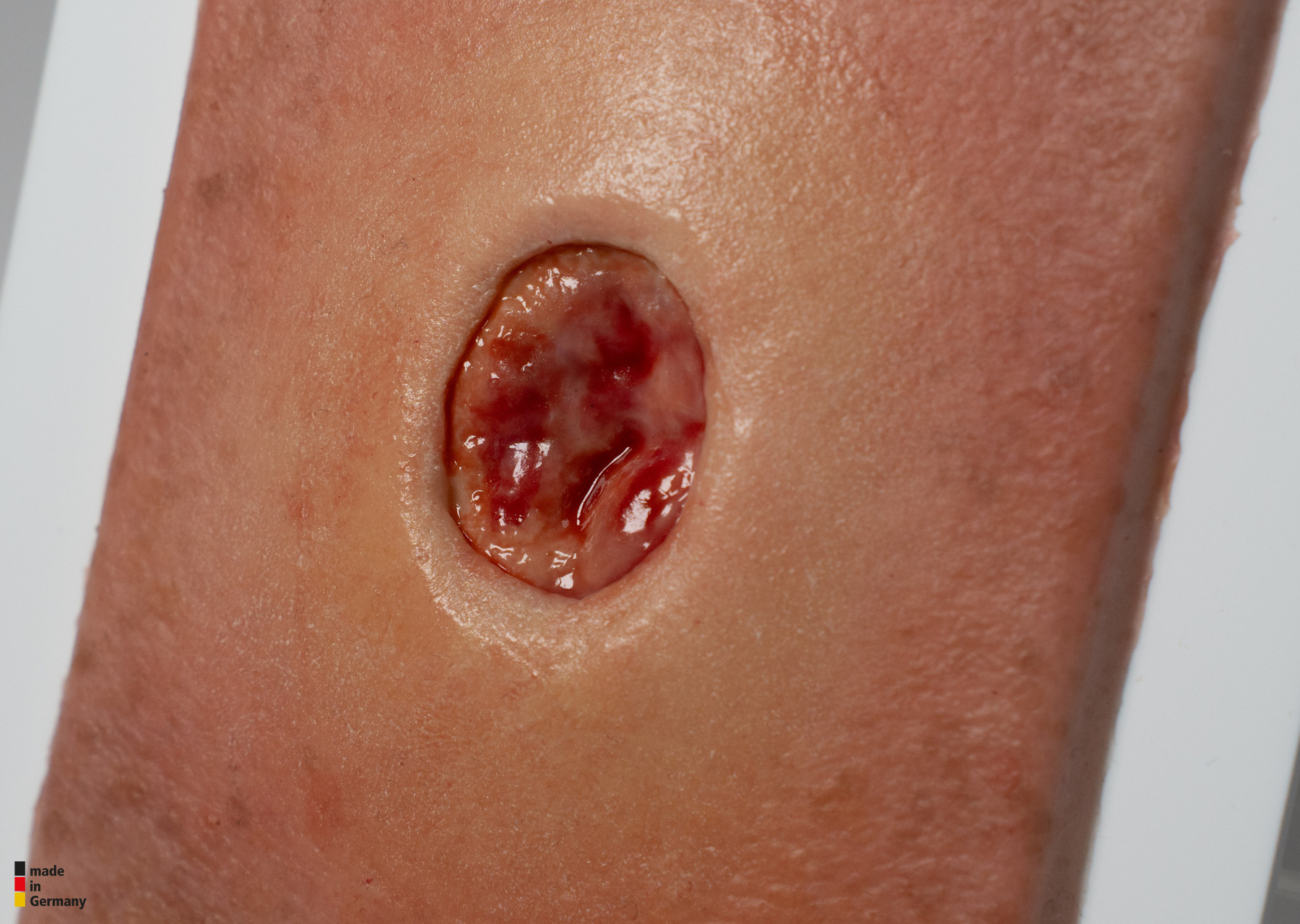 Pocketwound Keratinization - Image 2