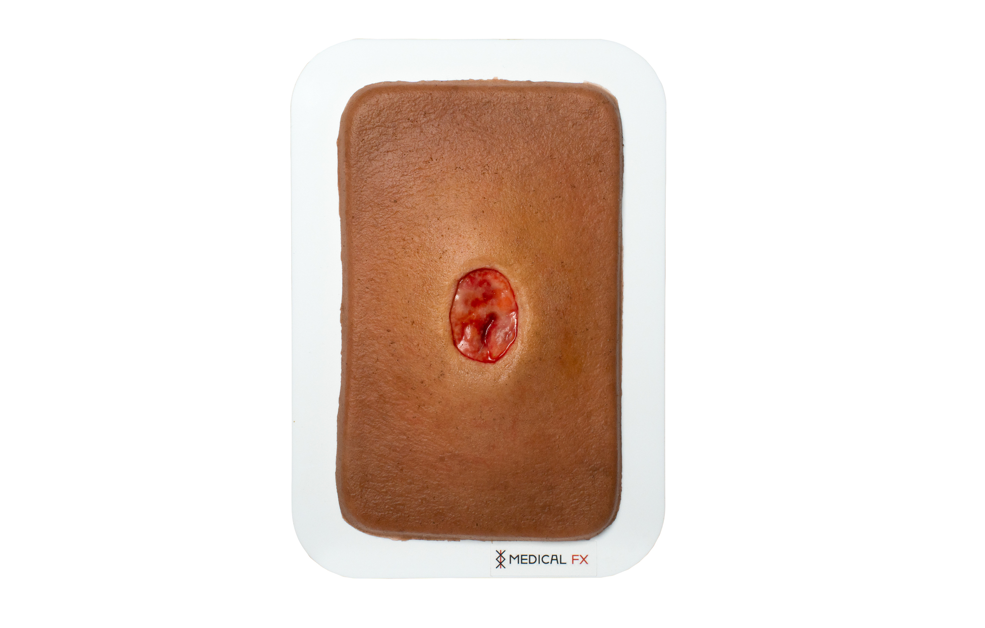 Pocketwunde Verhornung – Bild 7