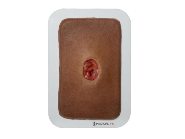 Pocketwound Keratinization - Image 7