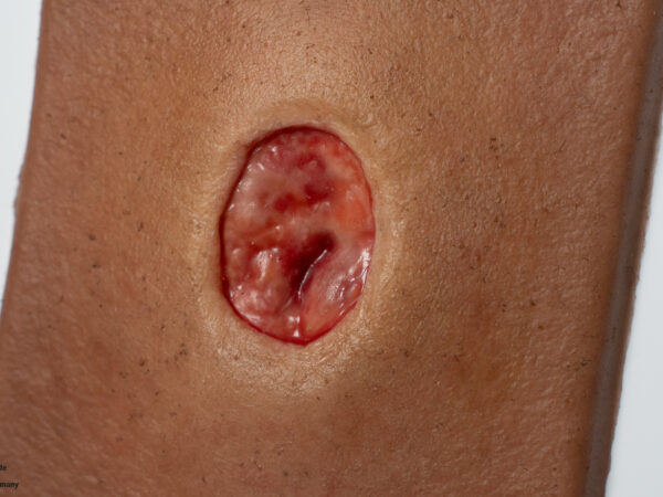 Pocketwound Keratinization - Image 3