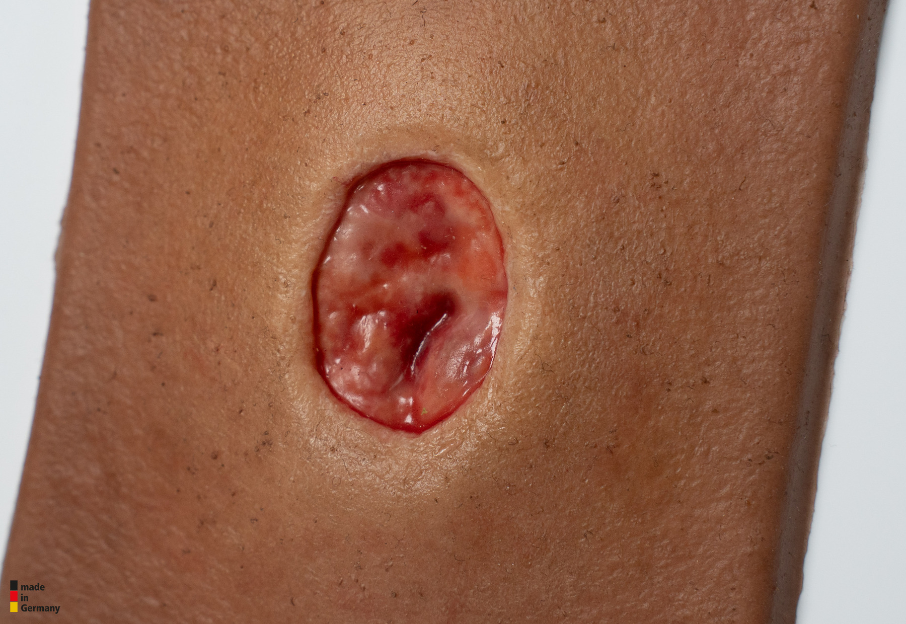 Pocketwound Keratinization - Image 3