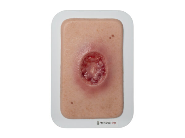 Pocketwound 수술 상처 (MOHS)