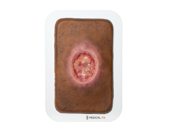 Pocketwound 手術創(MOHS)モデル - Image 6