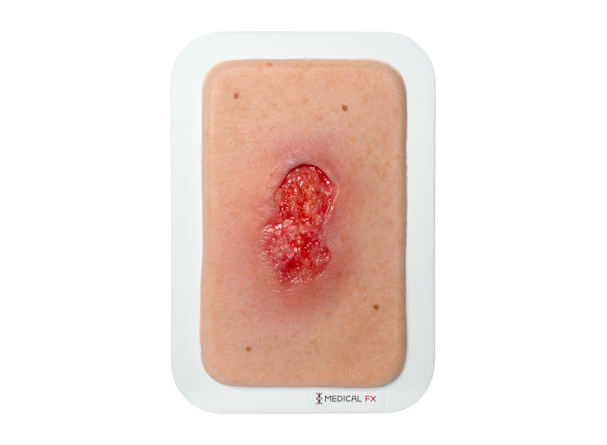 Pocketwunde Granulation mit Unterminierung – Bild 1
