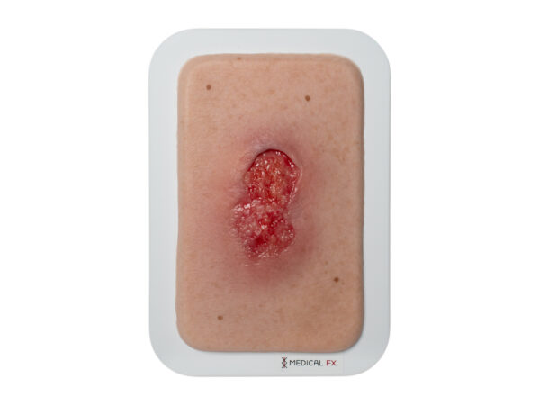 Pocketwound Granulation