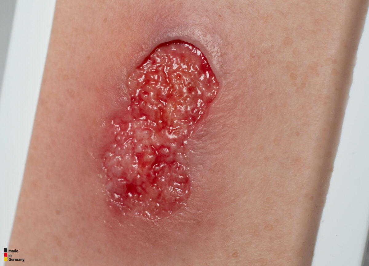 Pocketwunde Granulation mit Unterminierung