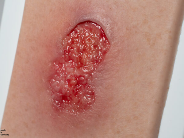 Pocketwunde Granulation mit Unterminierung – Bild 2