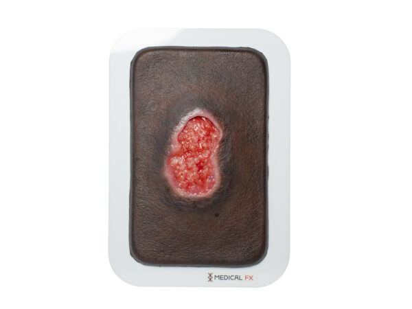 Pocketwunde Granulation mit Unterminierung – Bild 6