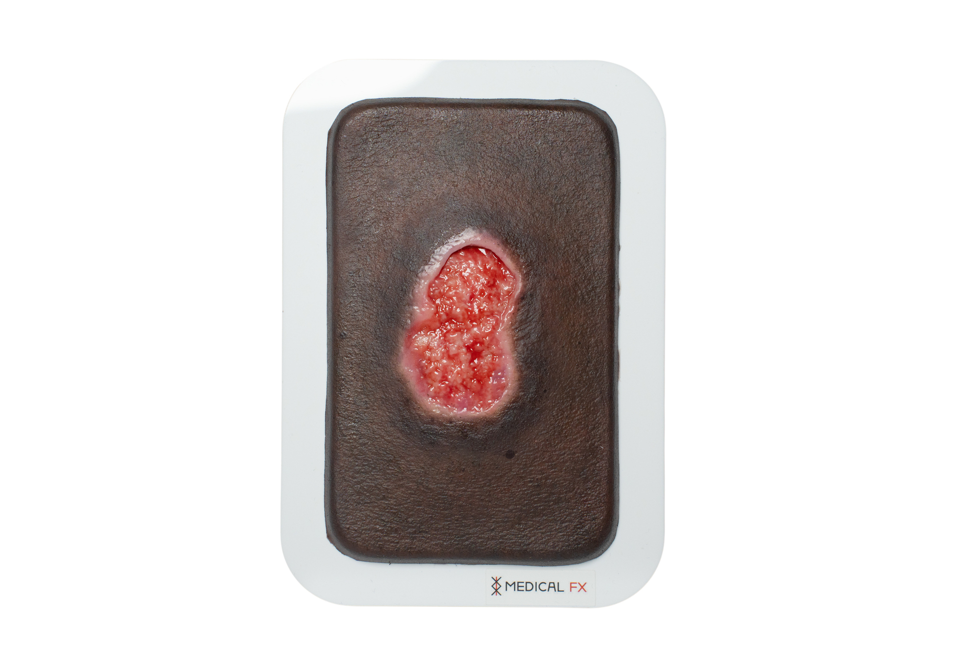 Pocketwunde Granulation mit Unterminierung – Bild 6