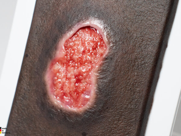 Pocketwunde Granulation mit Unterminierung – Bild 3