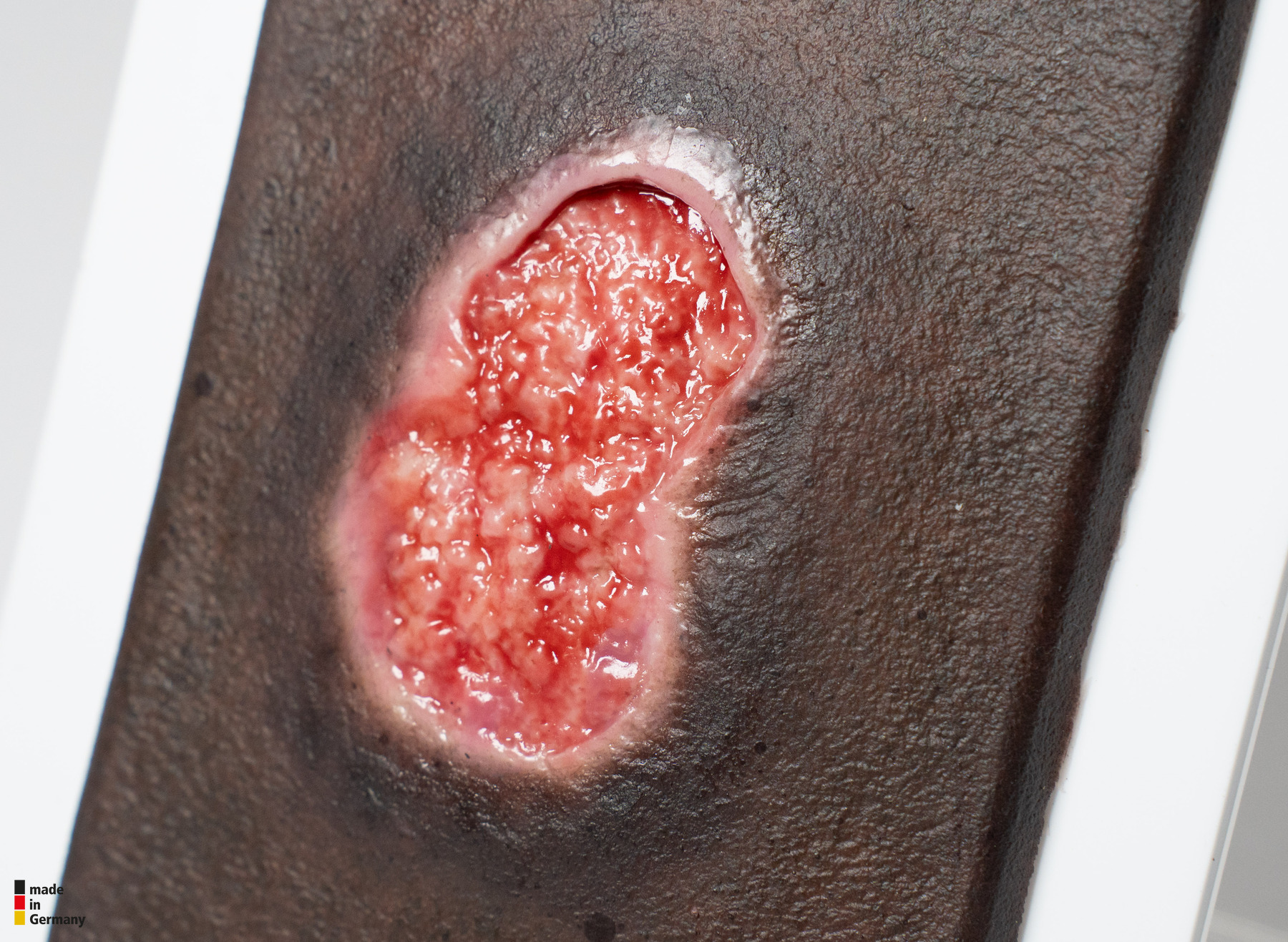 Pocketwunde Granulation mit Unterminierung – Bild 3