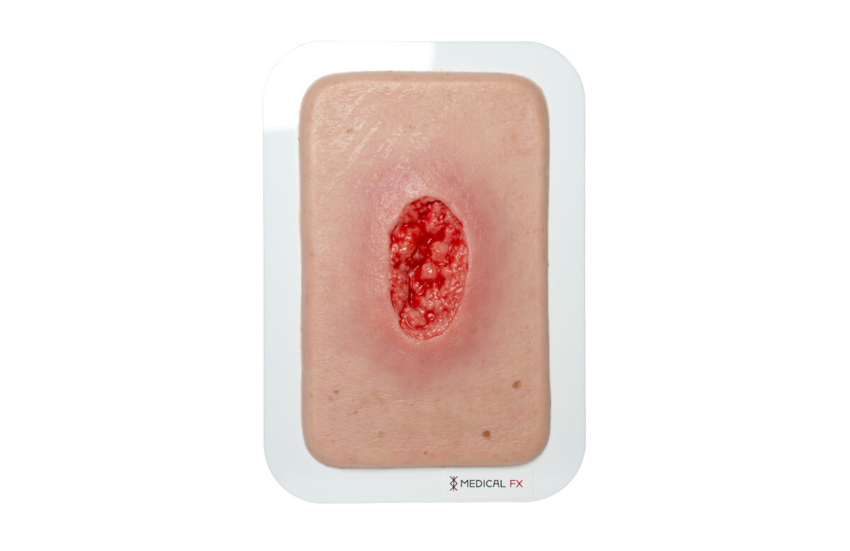 Pocketwunde Hypergranulation tief