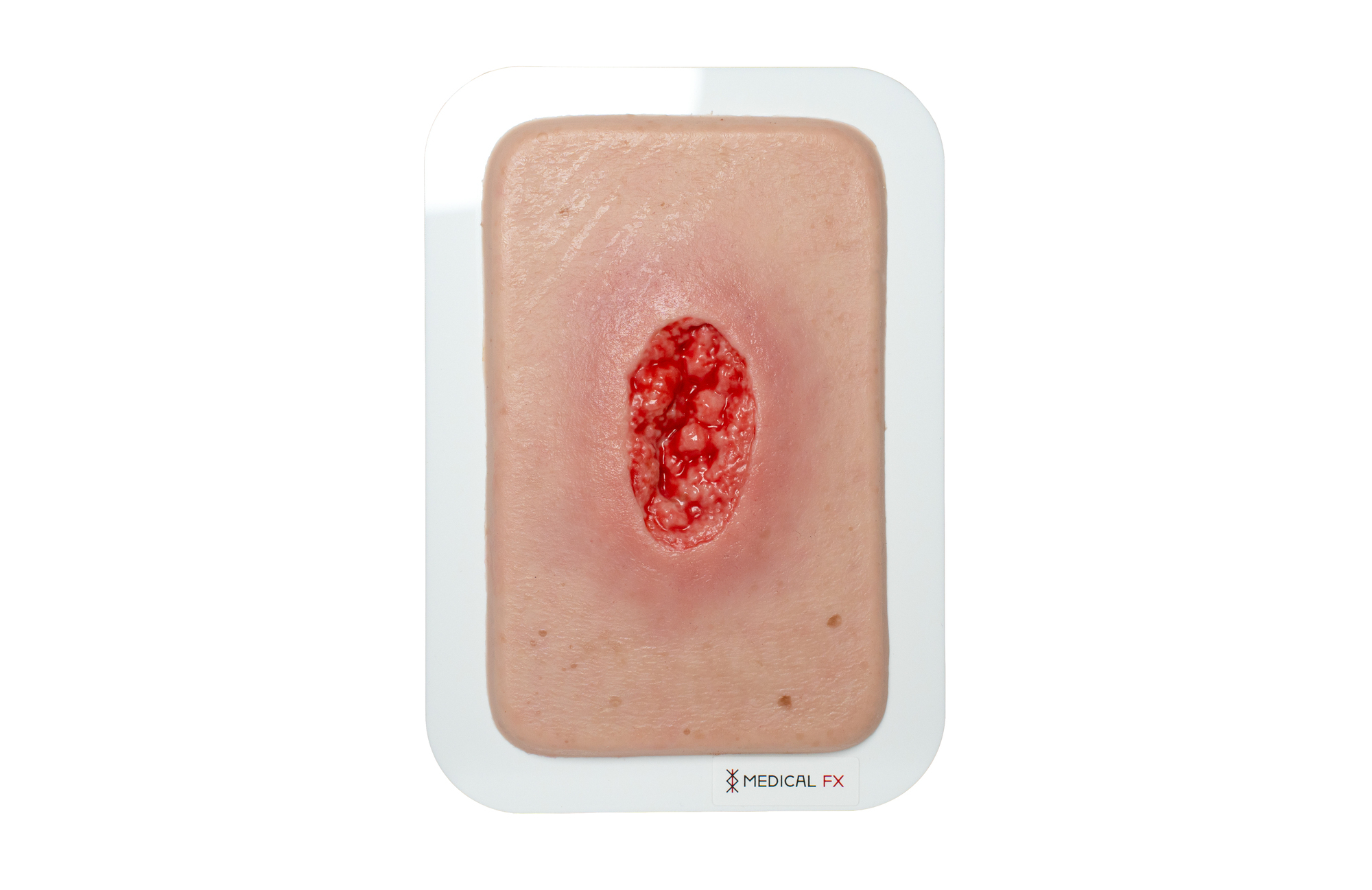 Pocketwunde Hypergranulation tief – Bild 1