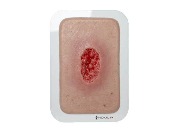 Pocketwound Hypergranulation