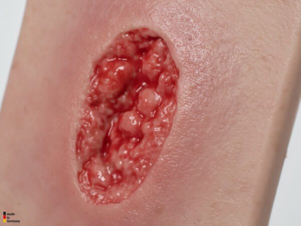 Pocketwunde Hypergranulation tief – Bild 3