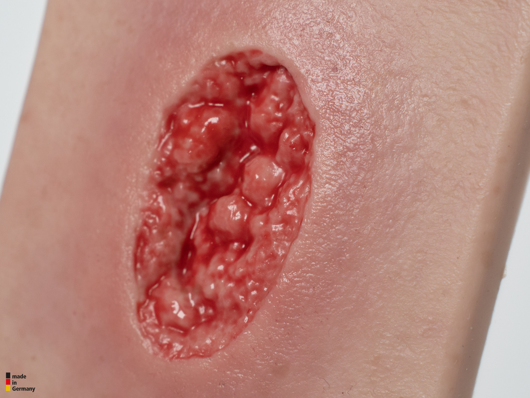 Pocketwunde Hypergranulation tief – Bild 3