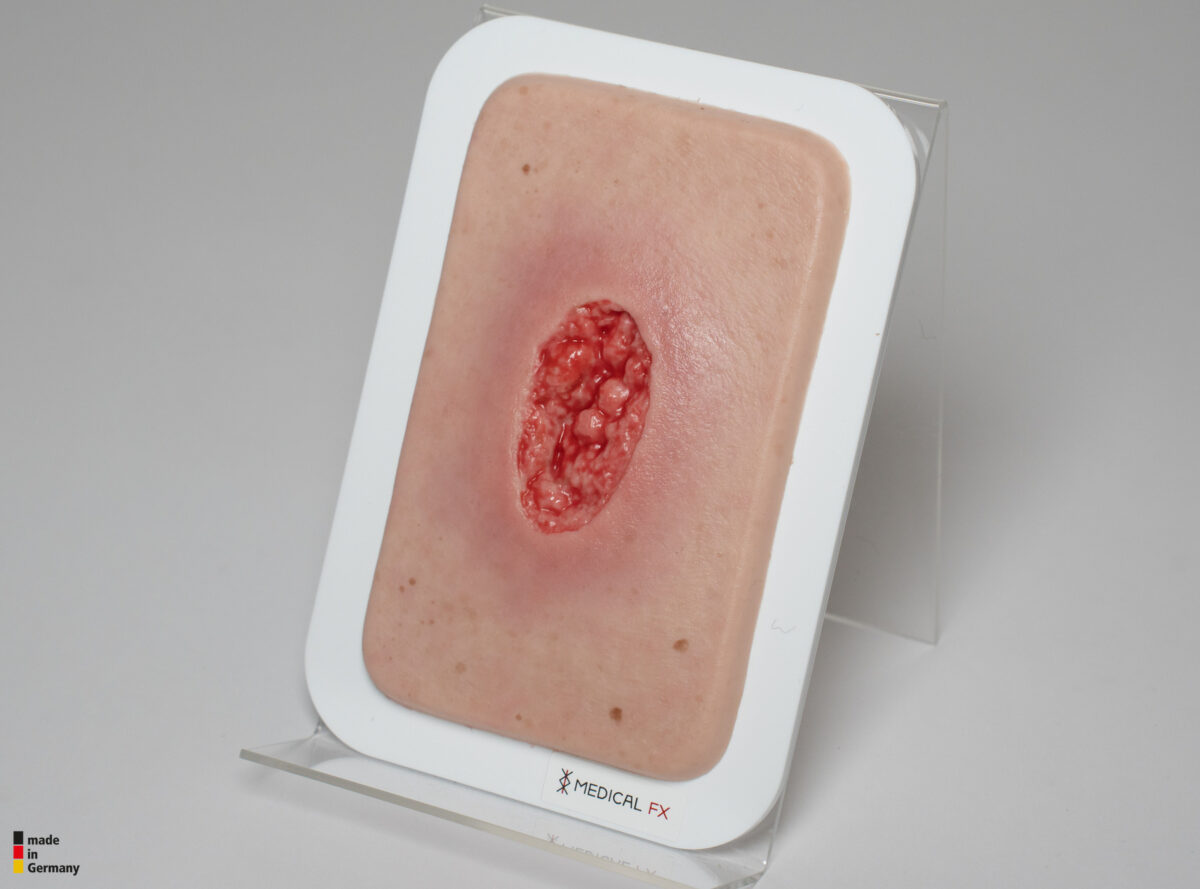 Pocketwunde Hypergranulation tief