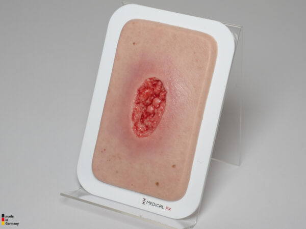 Pocketwunde Hypergranulation tief – Bild 5