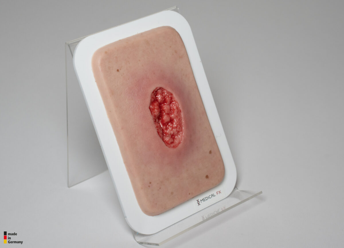 Pocketwunde Hypergranulation tief