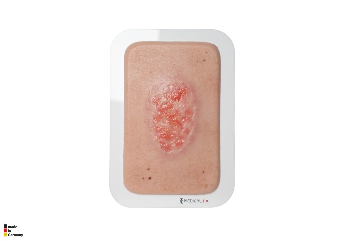 Pocketwunde Epithelisierung