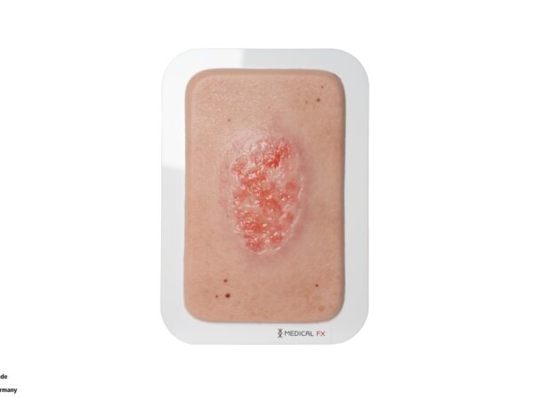 Pocketwunde Epithelisierung