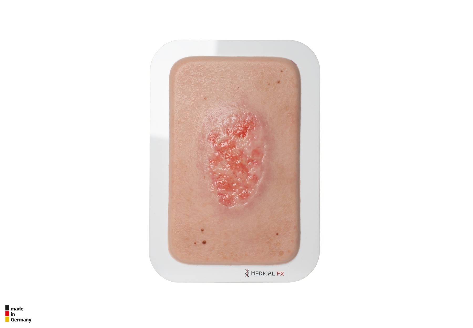 Pocketwunde Epithelisierung – Bild 1