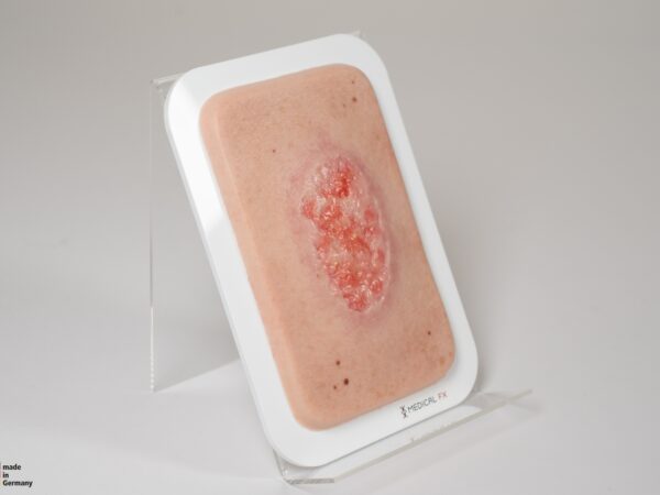 Pocketwunde Epithelisierung – Bild 4