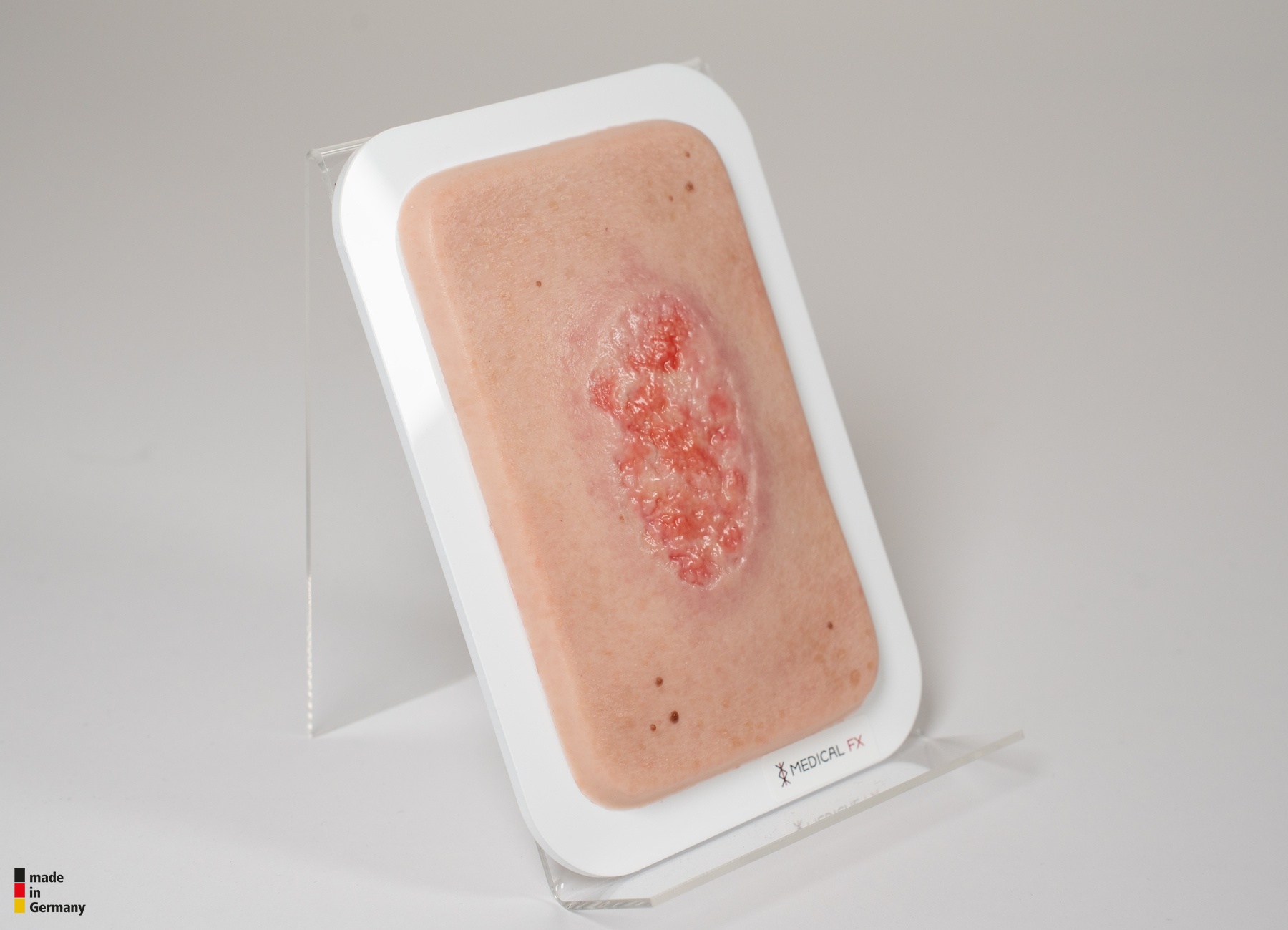 Pocketwunde Epithelisierung – Bild 4