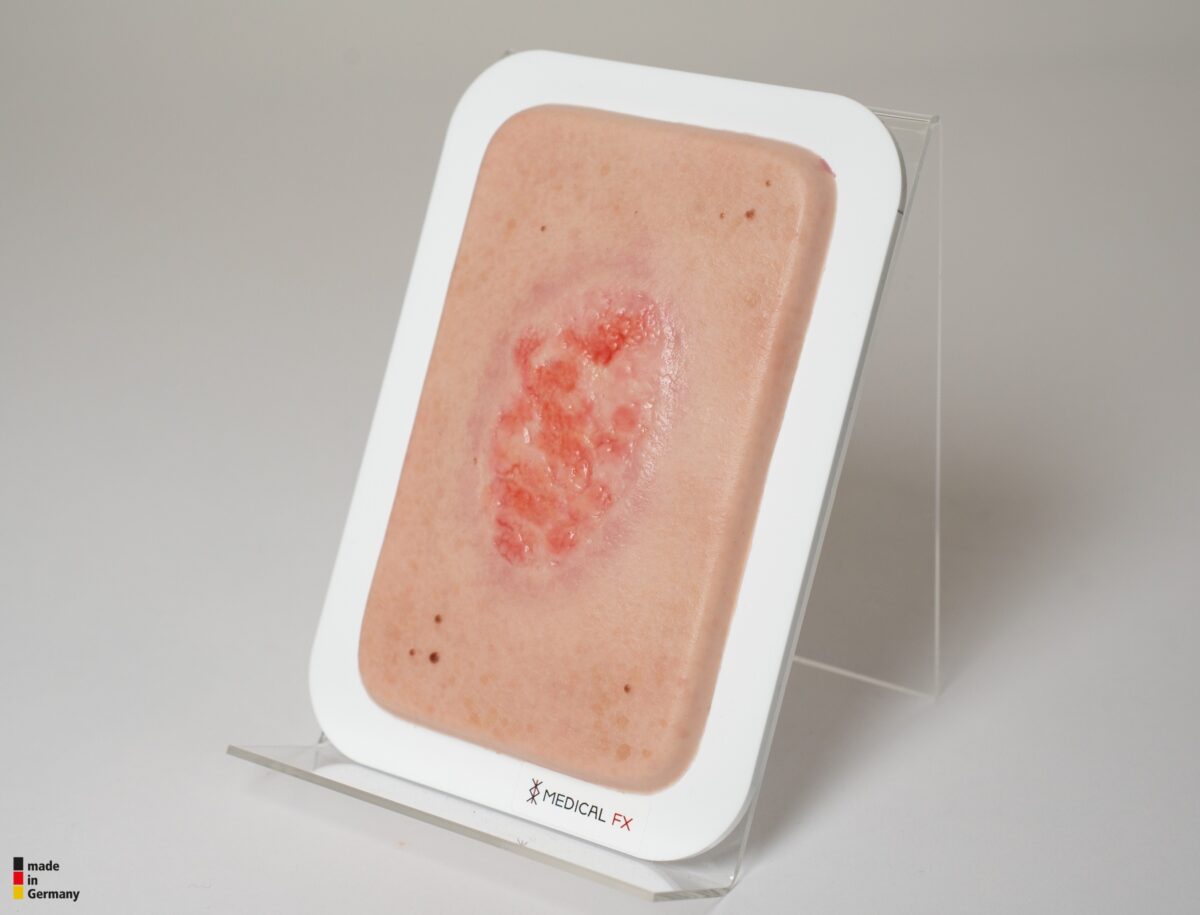 Pocketwunde Epithelisierung