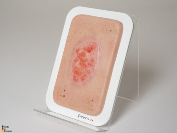Pocketwunde Epithelisierung – Bild 3