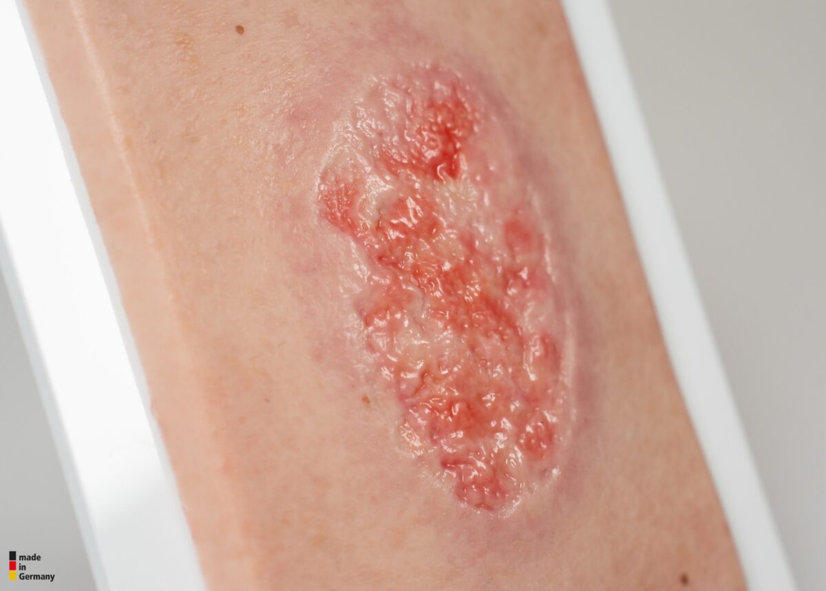 Pocketwunde Epithelisierung