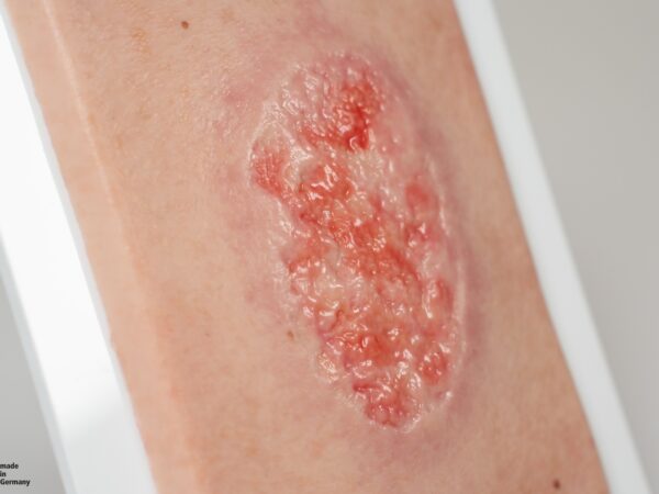 Pocketwunde Epithelisierung – Bild 5