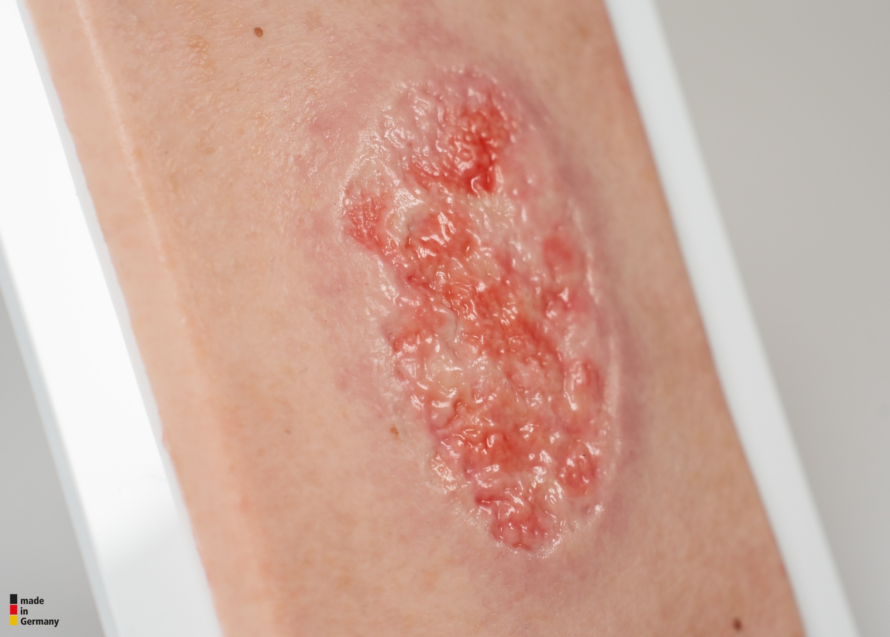 Pocketwunde Epithelisierung – Bild 5
