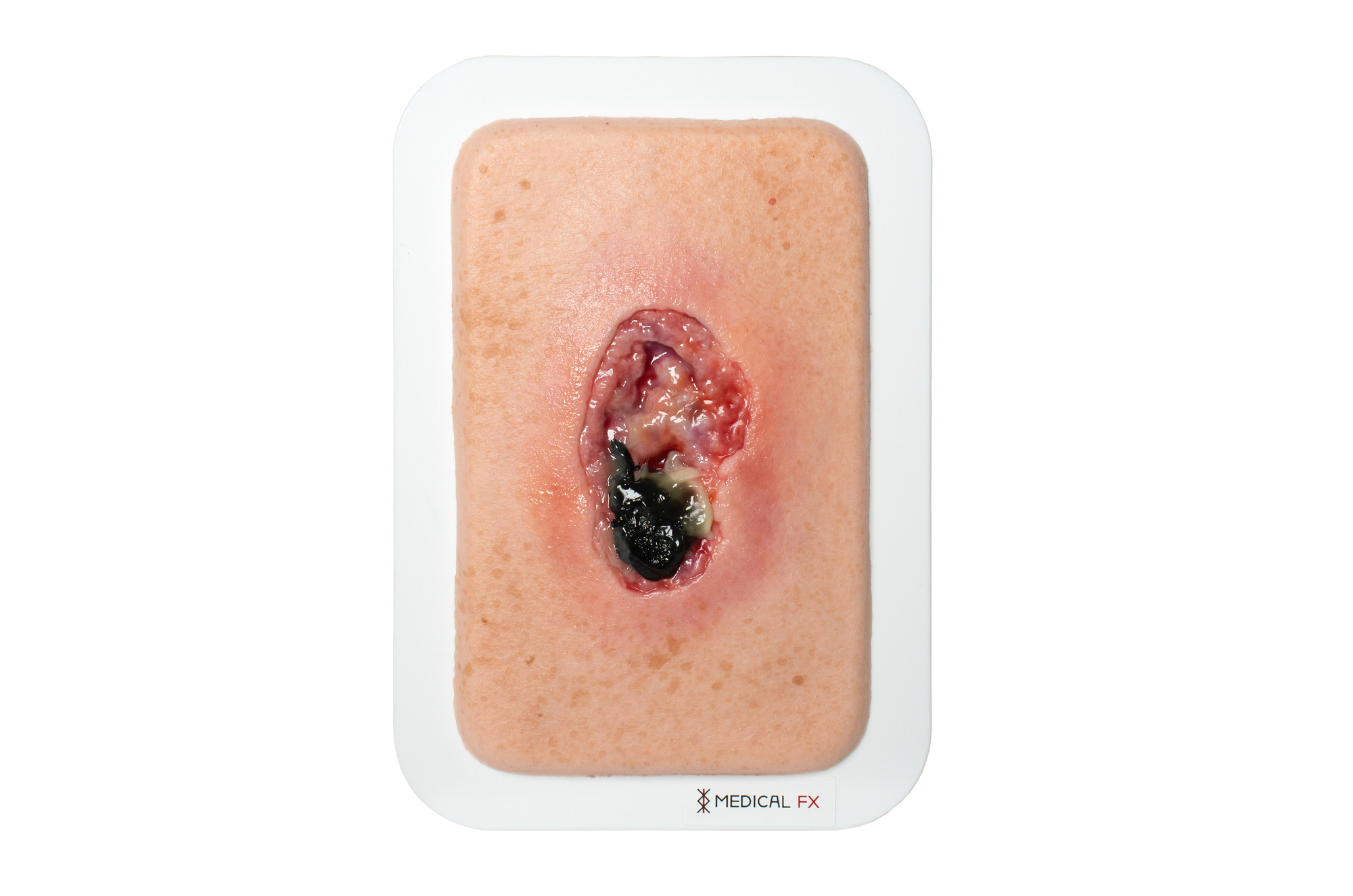 Pocketwunde Nekrose – Bild 1