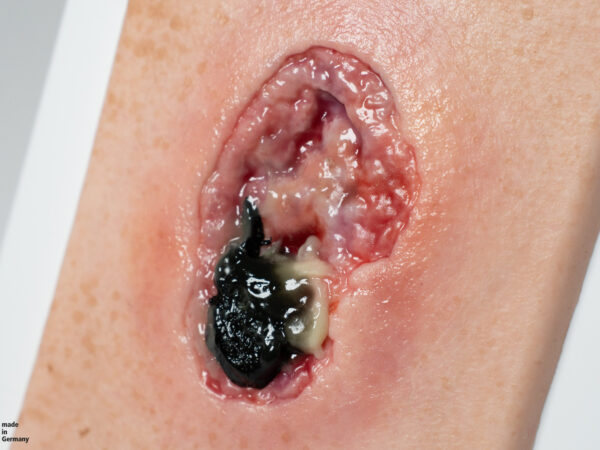 Pocketwound 壊死モデル - Image 2