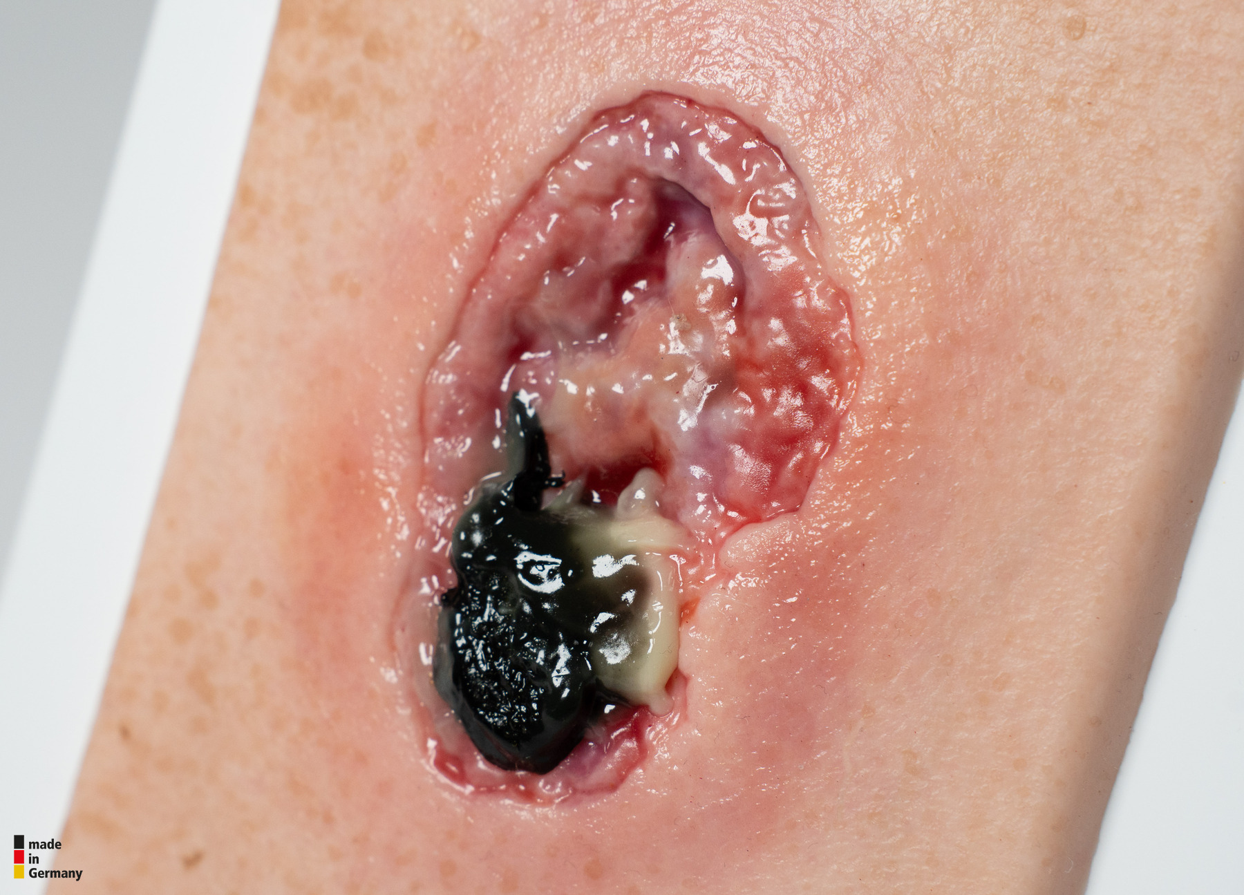 Pocketwound 壊死モデル - Image 2