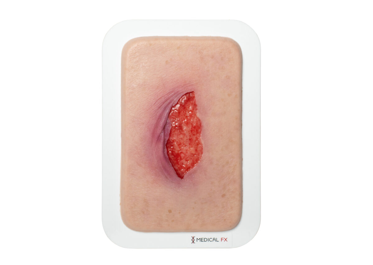 Pocketwound 皮膚裂傷モデル