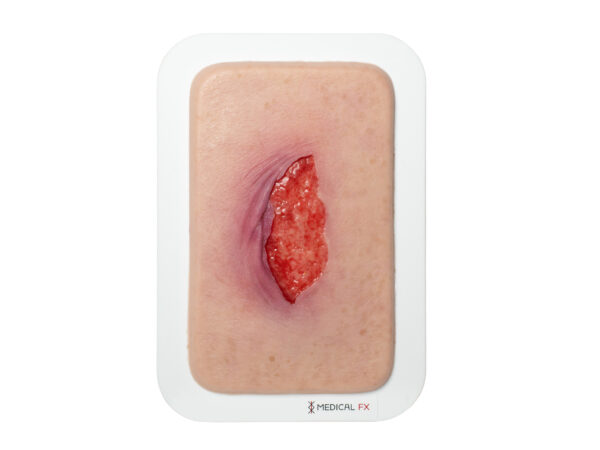 Pocketwunde Ablederung (Skin tears)