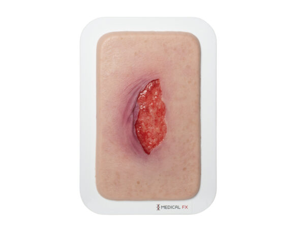 Pocketwound 피부 찢김