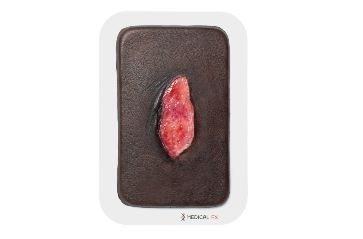 Pocketwound 皮膚裂傷モデル