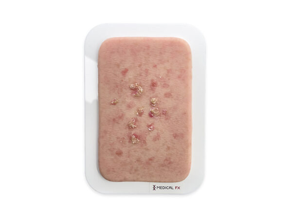 Pocketwunde Aktinische Keratose