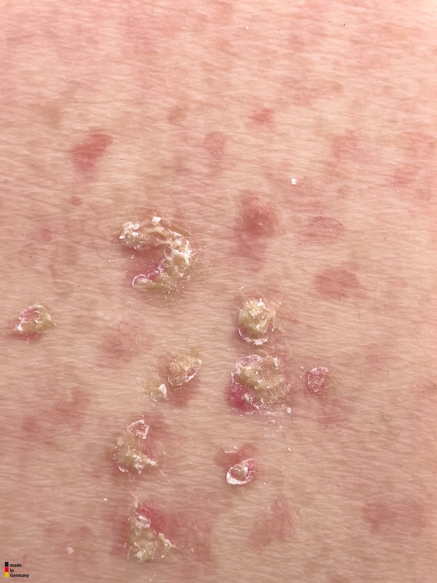 Pocketwunde Aktinische Keratose – Bild 2