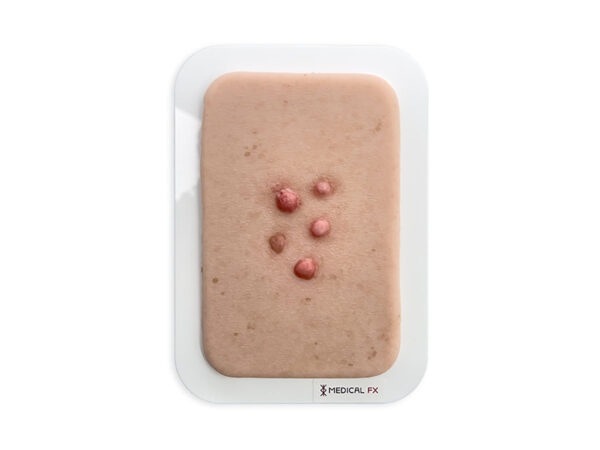 Pocketwunde Dermafibrom