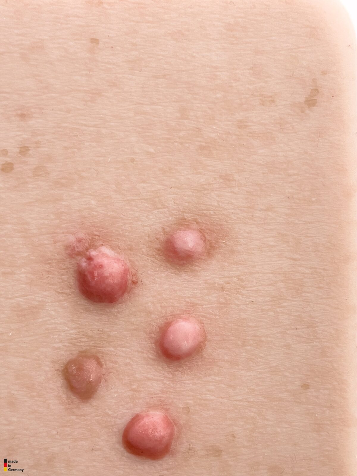Pocketwunde Dermafibrom