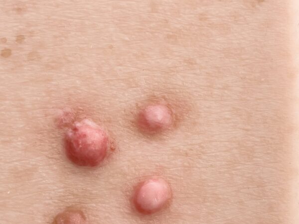 Pocketwunde Dermafibrom – Bild 2