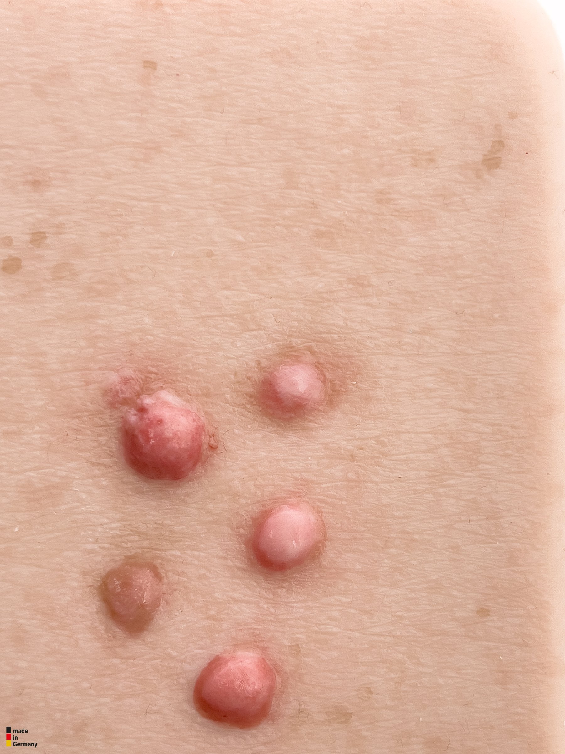 Pocketwunde Dermafibrom – Bild 2
